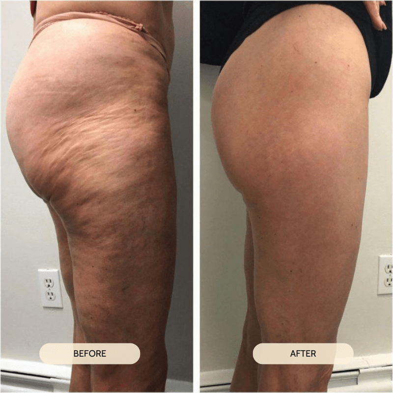 Lymphatic Drain Kit 2.0 - Anti-Cellulite Oil & Roller