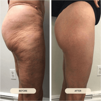 Lymphatic Drain Kit 2.0 - Anti-Cellulite Oil & Roller